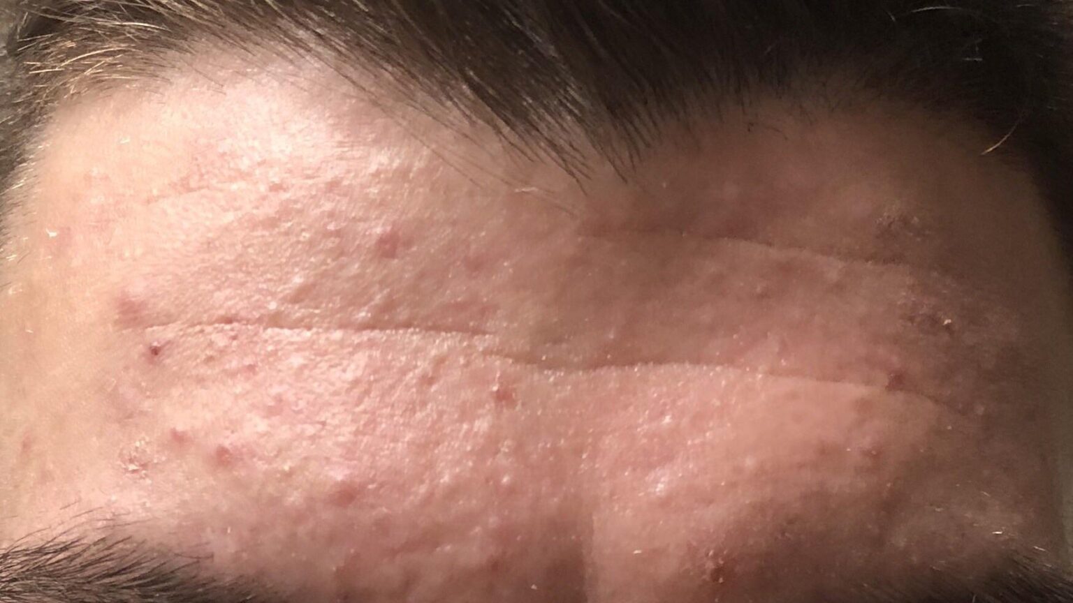 Addio acne maschile, basta solo un composto per avere una pelle radiosa e compatta