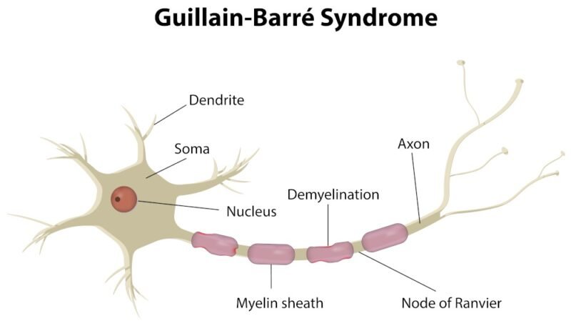Sindrome di Guillain-Barré, per saperne di più si questa rara malattia neurologica