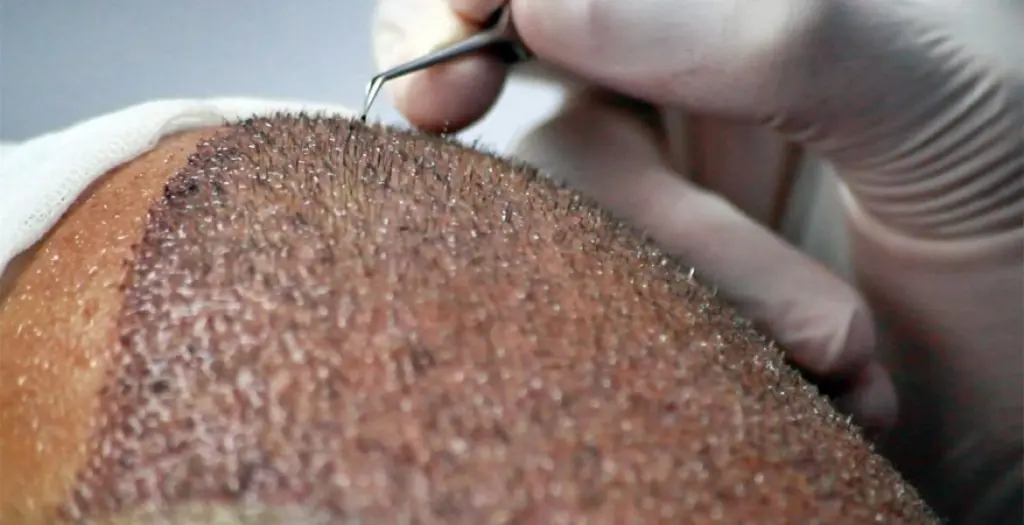 La Rivoluzione dei Trapianti di Capelli in Turchia, Sotto i Riflettori di Vera Clinic