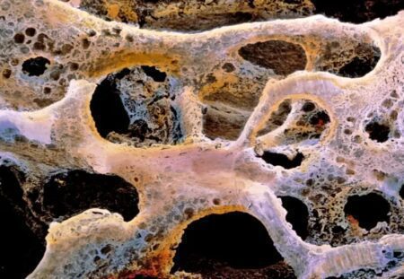 Osteoporosi negli Uomini: Come Riconoscerla, Prevenirla e Trattarla