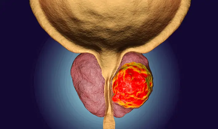 Come riconoscere i sintomi del tumore alla prostata e cosa fare per prevenirlo.