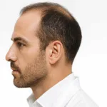 rimedi più efficaci per la calvizie maschile