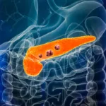 Ricercatori spagnoli annunciano un risultato storico contro l'adenocarcinoma duttale pancreatico, la forma più letale di tumore al pancreas: una terapia combinata elimina completamente le cellule tumorali nei modelli animali.​